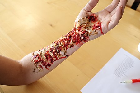 Arm einer Person mit einer größeren Verletzung über die gesamte Länge